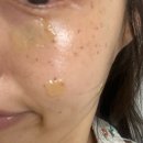 기미 잡티 흑자 고민 루비레이저 일주일 후기 &lt;천안 얼라이브 피부과&gt; 루비레이저 / 천안 피부과 / 천안...