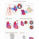 [간편]2대 심장질환 진단비(1년50%) 특별약관 이미지