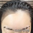 올곧은병원 | 대구 수성구 자연스러운 무통 반영구 6D 헤어라인 문신 가격 할인중