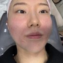 [부산/서면피부과] 부산 리즈네 스킨부스터 후기 #통증&amp;엠보싱 #스킨부스터추천