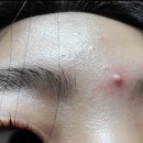 예쁠래에스테틱 | 광주 여드름관리 :: 예쁠래에스테틱 에서 물톡스 리얼 후기 (웨딩관리)