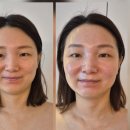최인경 뷰티 | [하양입체윤곽관리] 출산 후 처진 얼굴 라인, 최인경뷰티에서 리프팅 고민 해결했어요!