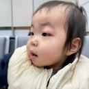 수병원 | 13개월 아기 침대 모서리 사고 - 눈 찢어짐으로 한강수병원 눈가 봉합 수술 후기