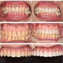 에나멜 치과기공소 | [공지] 라미네이트 고민 중이라면 이 글 먼저 보세요. 무삭제/최소삭제 라미네이트 완벽 정리 A to Z