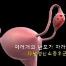 다낭성난소증후군 환자와 에스트로 밸런스 복용 이미지