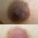 진메디팜 | 순천 유륜 색소침착 관리 후기 1개월 톤 변화