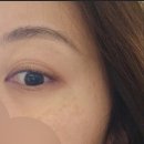 효성의원 | 효성의원 점빼고 1년 지난 후기