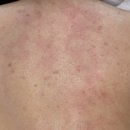 스킨올 | 여름 대비 등관리 시작! 청주 올스킨 다녀온 후기