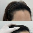 수정헤어라인 네이버블로그