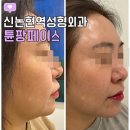타임성형외과의원 | 신논현역성형외과 튠페이스 얼굴지방 이중턱 날려버리기
