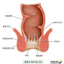 항문암은 항문에 생기는 악성 종양(암) 이미지