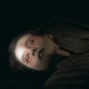 방사선병의 초기증상, 눈의 부종...둘로 보이는 현상(복시).. 이미지