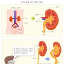 신경인성 방광[neurogenic bladder] 이미지