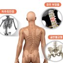 가양메트로정형외과의원 | 척추측만증 허리통증을 겪는 트레이너(외측굴곡)