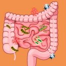 방광소장 누공[Vesicointestinal fistula]신장비뇨기질환 이미지