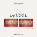 자모치과의원 | 나비치아교정, 사랑니 발치 없이 교정하기! (문정 굿플란트치과 교정과)