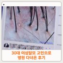 모모의원 | 이제 30살인데.. 여성 탈모인 '가르마 탈모' 고민으로 모모의원 다녀온 후기