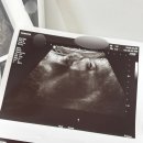 도우미실버케어 | 30-35주차 임신 기록 : 출산휴가, 만삭촬영, 산전마사지, 첫 태동검사, 막달검사, 분만방식 결정, Y존...