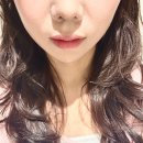 세상의모든아름다움의원 | 신사역피부과 에이브의원 올리디아365 시간지날수록 예뻐졌던 10일후기