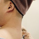 림한의원 | 대구 편평사마귀 쥐젖 성지 한의원 갯수제한없이 무제한 제거