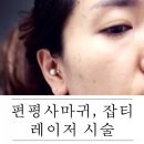 잡티 제거하러 갔다가 편평사마귀 제거