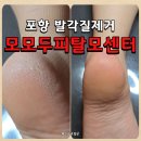포항 발각질제거 전문 모모두피탈모센터에서 아기발 만들기 후기