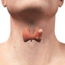 갑상선 결절[thyroid nodule] 이미지