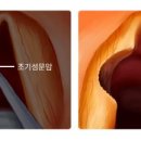작은후두암 네이버블로그