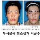 미병원 | 턱끝수술 회복기간 짧은 투시윤곽술