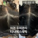 티나스칼프 | 이천두피관리 티나에스테틱 6번째 방문: 두 번째 풍성 모발 두피관리 메조란트