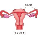 과다월경 (Hypermenorrhea) 여성 질환에 대하여 이미지