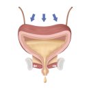 대구 경북 구미 김천 상주 문경, 만성 방광염 한방 치료 한약 이미지