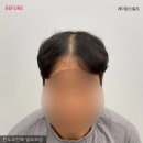 레이븐스칼프