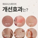 제네시스 | 제네시스 레이저 효과 후기 및 주기!