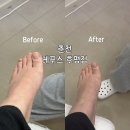 씨유 춘천후평점 | 춘천무좀 관리 후기 발톱무좀 레푸스 후평점에서 드디어 해결했어요