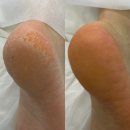 패디히얼