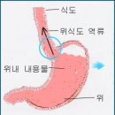 소아 위식도 역류[gastroesophageal reflux, GER] 이미지