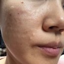 기계의원 | 홍대예쁨주의쁨의원 리쥬란힐러 3회 솔직 후기 (기계vs 손주사)