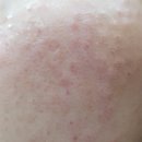 드림탑치과 | 물광주사 리얼후기(통증, 주의사항 포함)