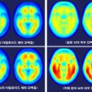 대상포진 백신에 치매 예방 효과…“발병률 20% 낮춰” 이미지