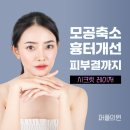 모공 레이저 종류 시크릿RF 이미지