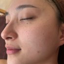 코스메디 | [강남 피부관리] 필로코스메디 문제성피부 팔자주름 관리 후기