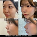 단차 | 무보형물코수술 코끝단차 걱정 NO - 후기방출