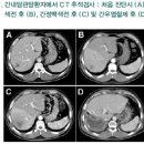 간세포암 환자에서 문맥 및 간정맥 색전술을 통해 간실질 위축을 유도한 후 시행된 우간절제술 이미지