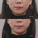 서울한의원 | [서울] 논현역한의원 안면비대칭교정 후기