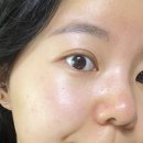 아이피부과 | 당산피부과 스킨부스터 쥬베룩아이 내돈내산 솔직후기