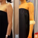 천호약국 | 천호 팔뚝 지방흡입주사 시술하고 바로 출근한 후기