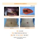 담낭용종수술후기. 건강검진 시 담낭에 1.6cm 가량의 용종이 보인다고 해서 큰 병원에 예약하고 기다리는데 수술 일정도 늦게... 이미지