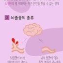 뇌혈관질환 전조증상 종류 예방법 알아두기 이미지
