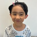 서초서울마더스성형외과의원 | 이마 미간 열상 봉합술 9개월, 흉터 레이저 6차 후기_마더스성형외과